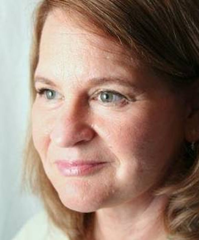 Facelift | Neck Lift Before & After Gallery - Patient 350605 - Image 4 - Scott Chapin, MD