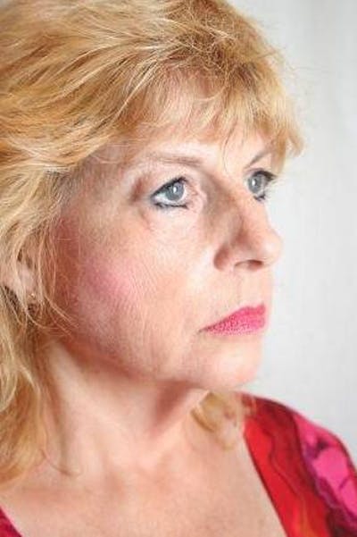 Facelift | Neck Lift Before & After Gallery - Patient 202763 - Image 1 - Scott Chapin, MD