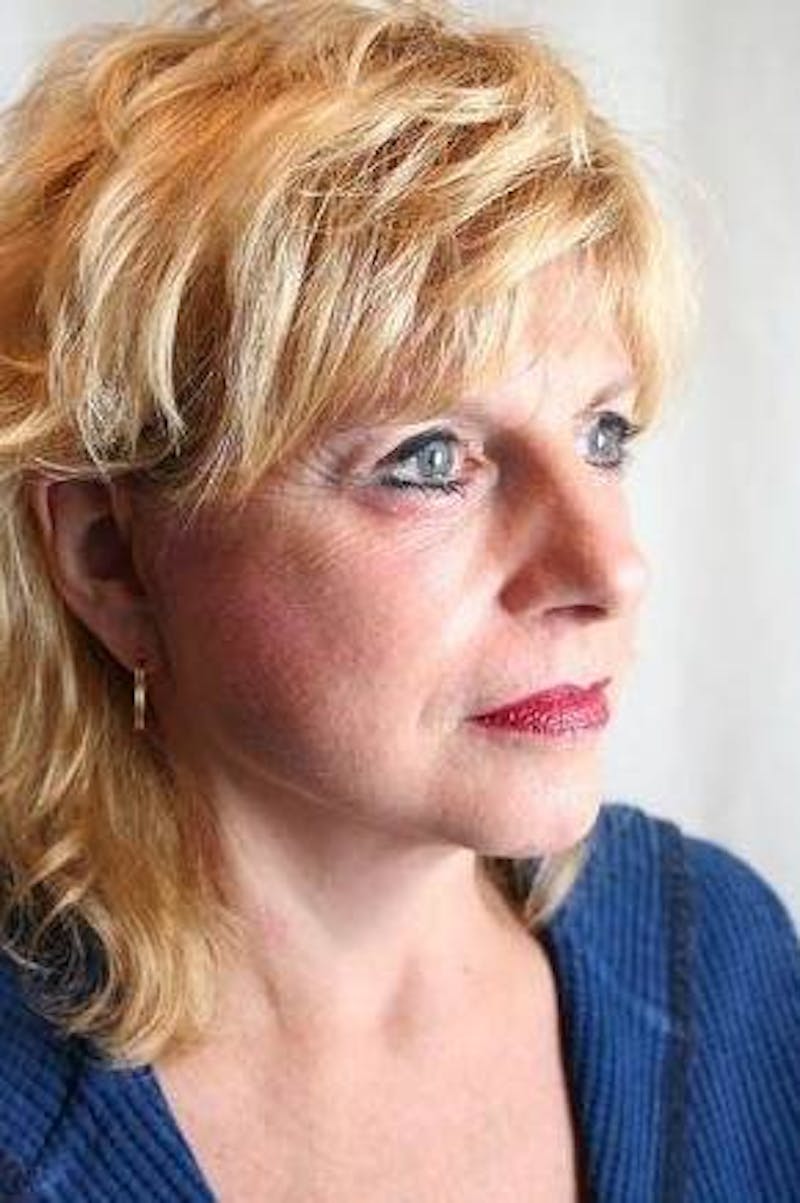 Facelift | Neck Lift Before & After Gallery - Patient 202763 - Image 2 - Scott Chapin, MD