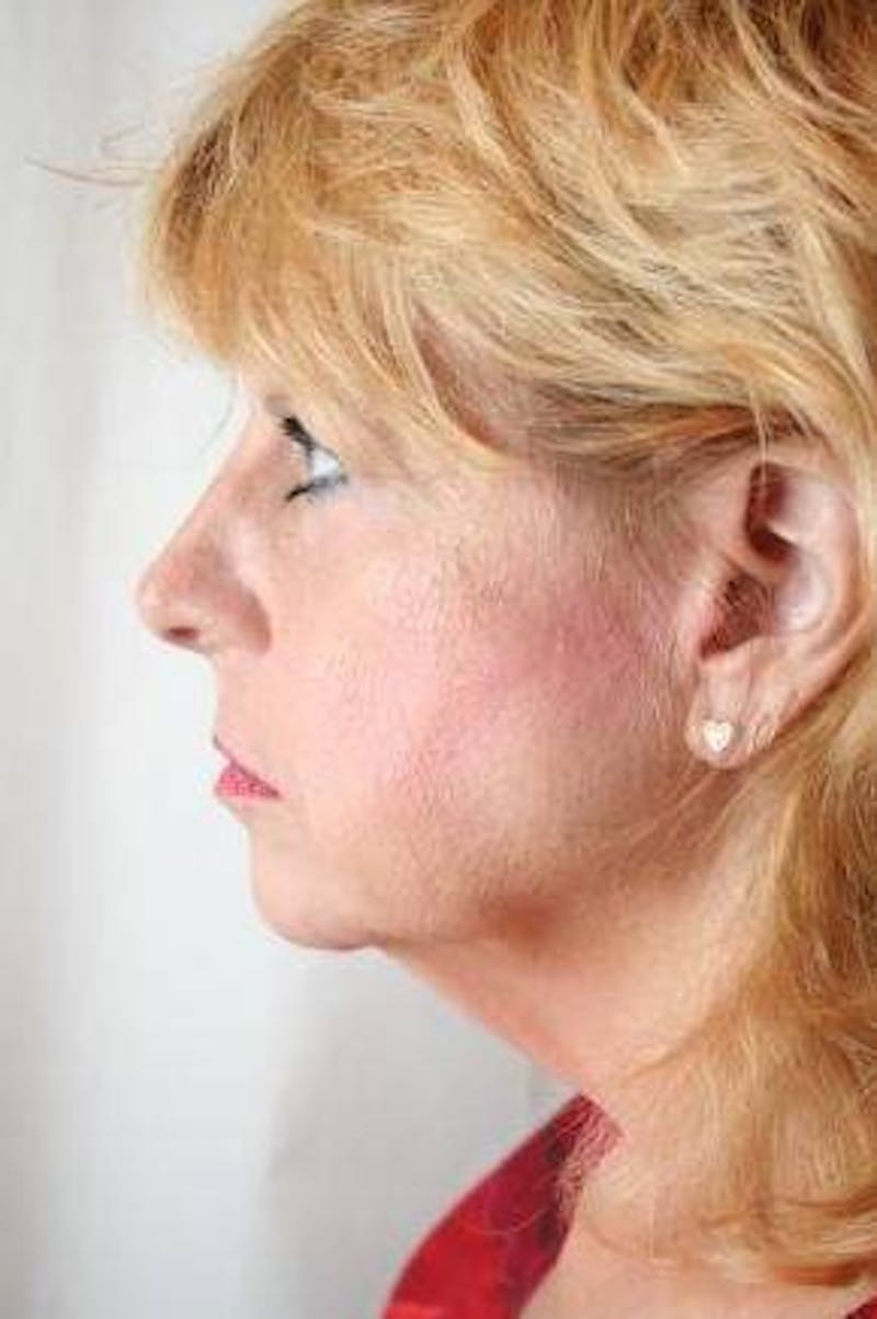 Facelift | Neck Lift Before & After Gallery - Patient 202763 - Image 3 - Scott Chapin, MD