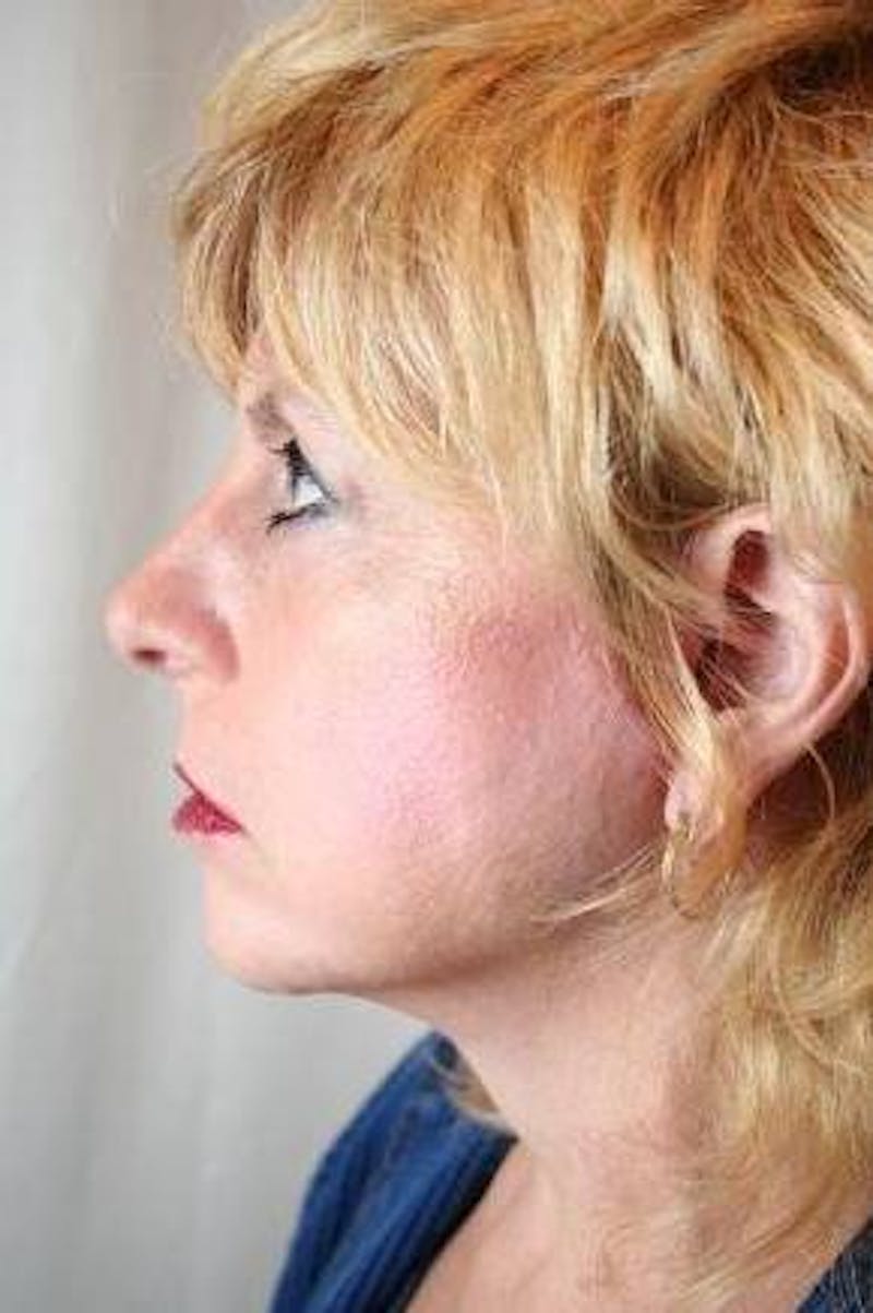 Facelift | Neck Lift Before & After Gallery - Patient 202763 - Image 4 - Scott Chapin, MD