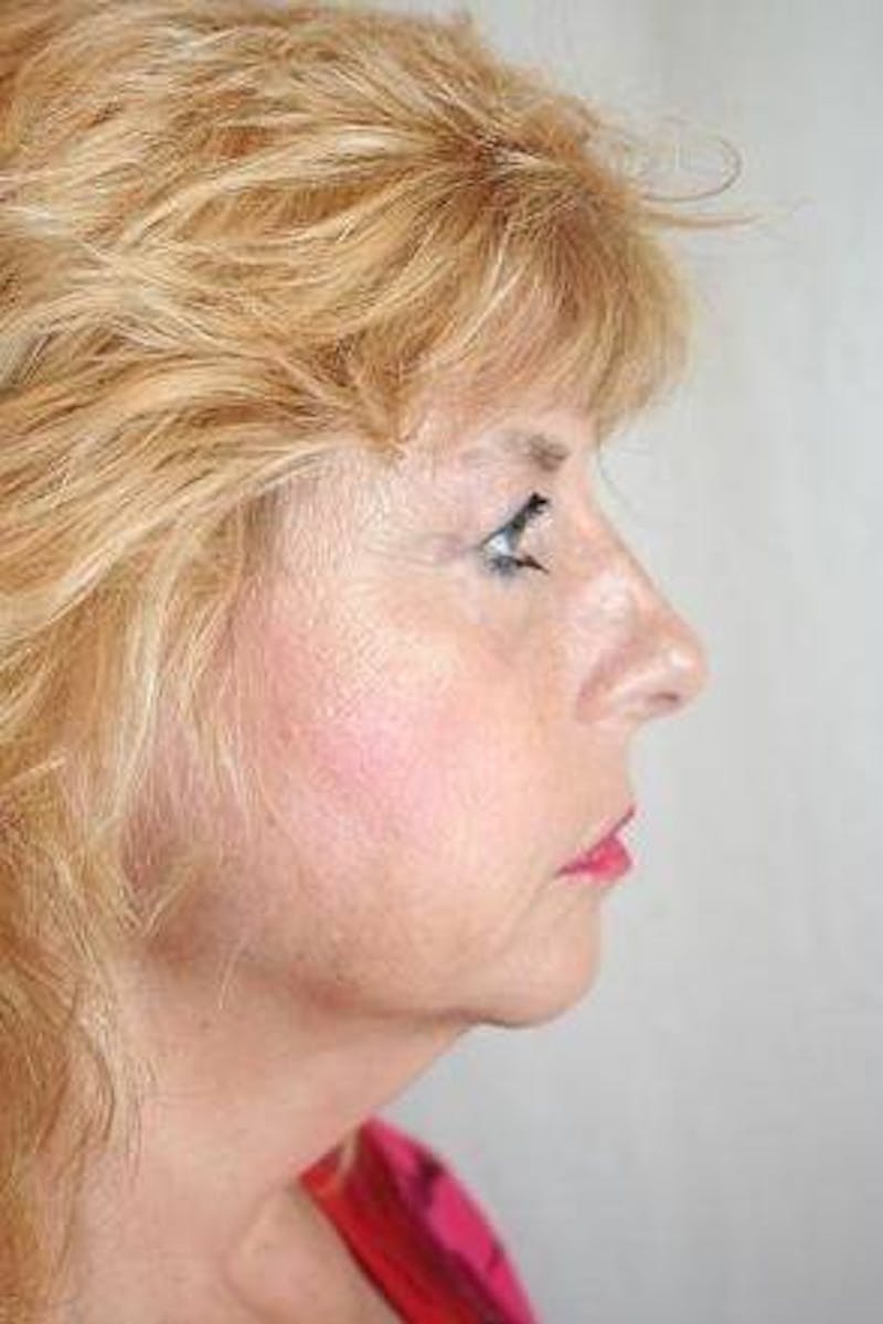 Facelift | Neck Lift Before & After Gallery - Patient 202763 - Image 5 - Scott Chapin, MD