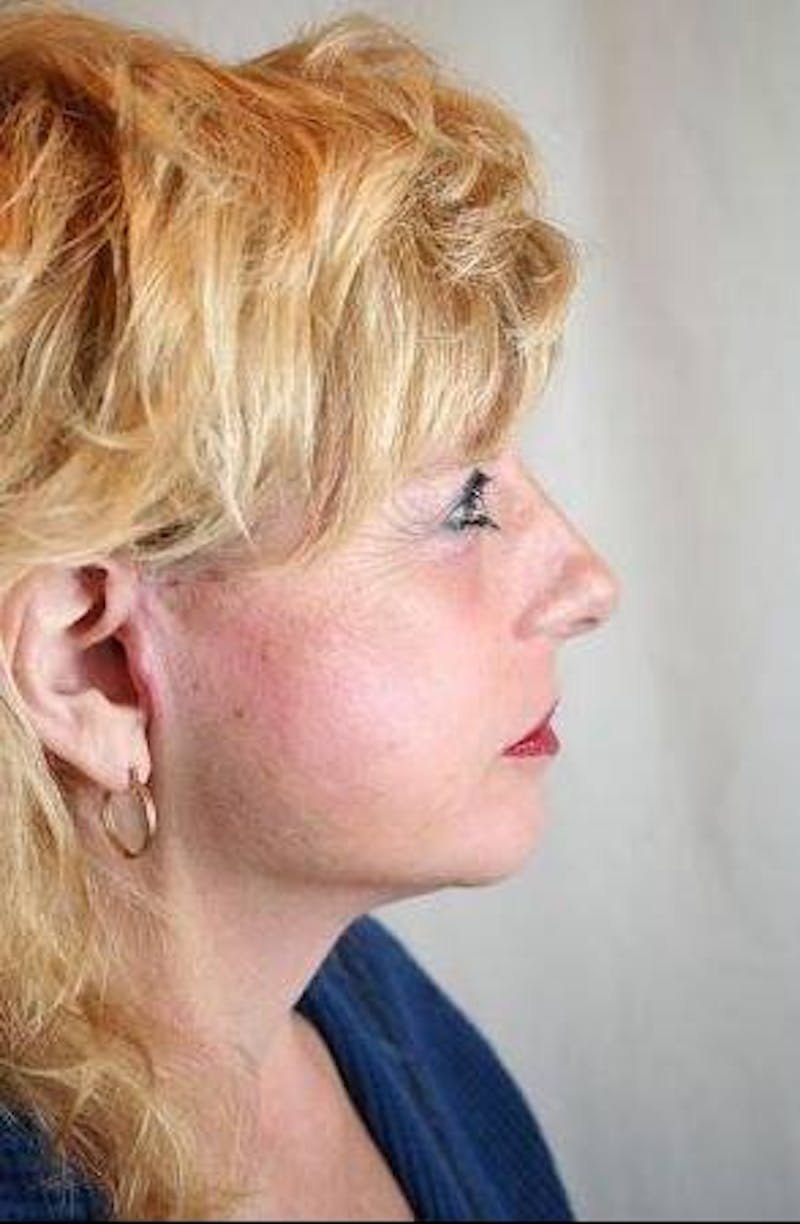 Facelift | Neck Lift Before & After Gallery - Patient 202763 - Image 6 - Scott Chapin, MD