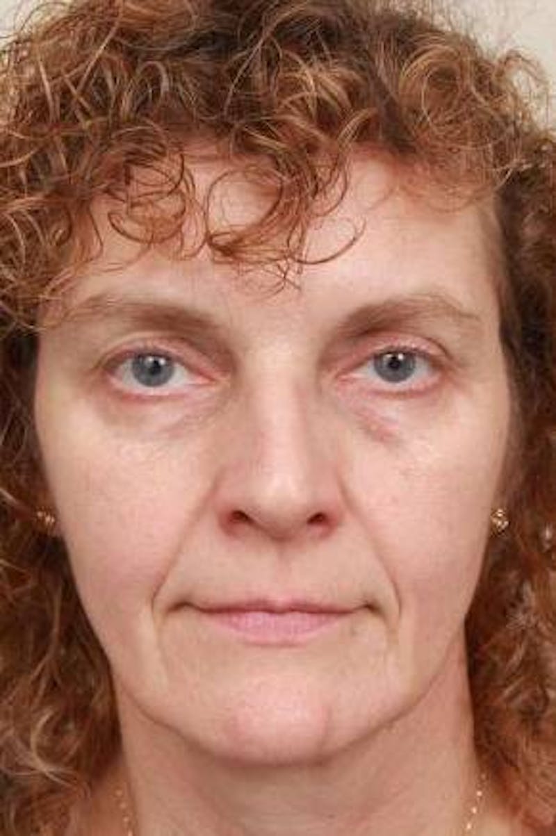 Facelift | Neck Lift Before & After Gallery - Patient 330715 - Image 3 - Scott Chapin, MD