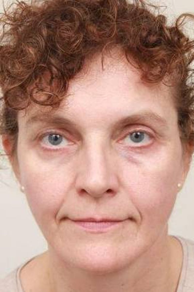 Facelift | Neck Lift Before & After Gallery - Patient 330715 - Image 4 - Scott Chapin, MD
