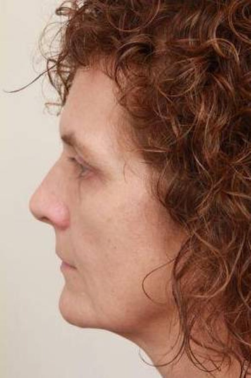 Facelift | Neck Lift Before & After Gallery - Patient 330715 - Image 5 - Scott Chapin, MD