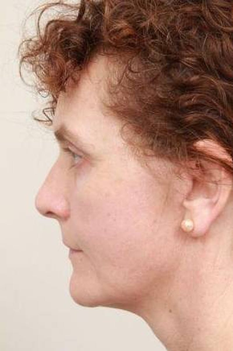 Facelift | Neck Lift Before & After Gallery - Patient 330715 - Image 6 - Scott Chapin, MD