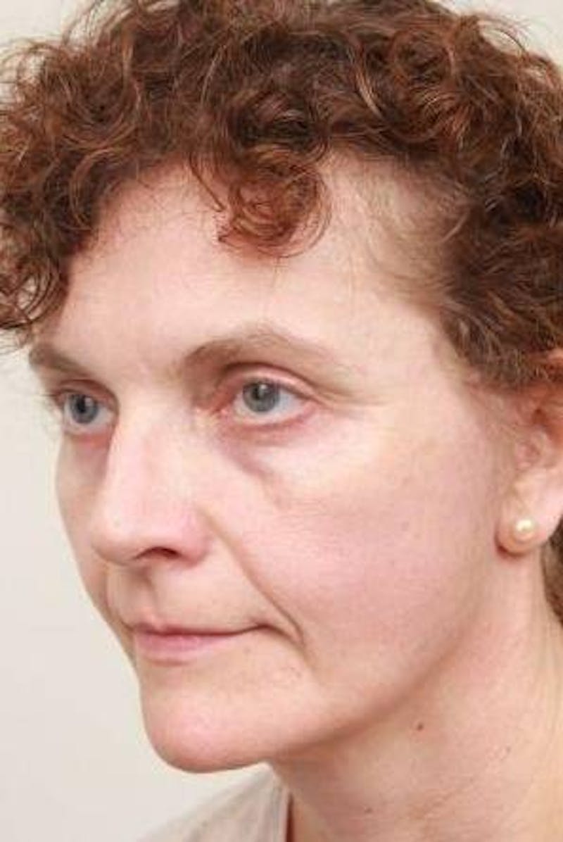 Facelift | Neck Lift Before & After Gallery - Patient 330715 - Image 2 - Scott Chapin, MD