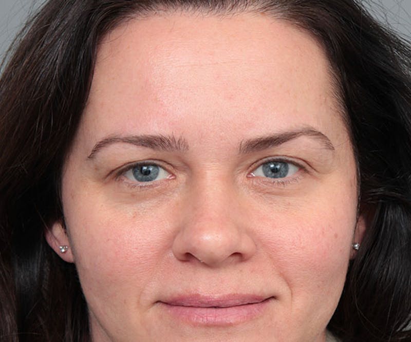 Eyelid Lift Before & After Gallery - Patient 261287 - Image 1 - Scott Chapin, MD