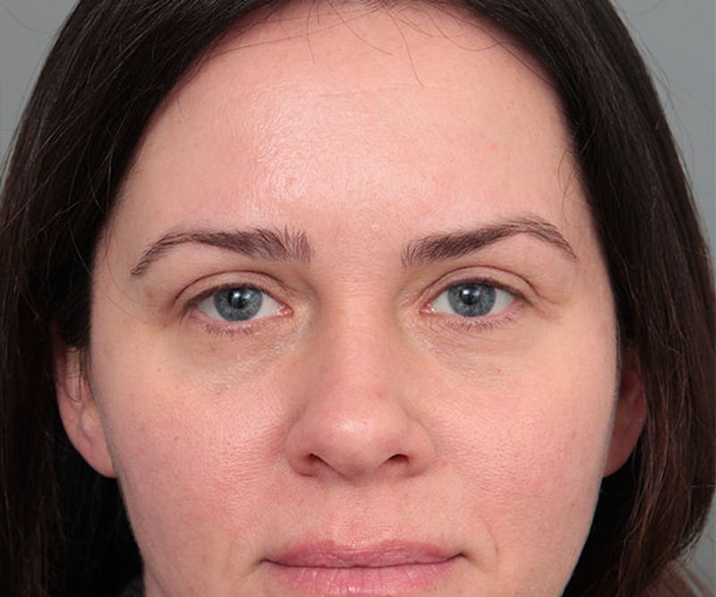 Eyelid Lift Before & After Gallery - Patient 261287 - Image 2 - Scott Chapin, MD