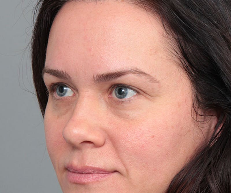 Eyelid Lift Before & After Gallery - Patient 261287 - Image 3 - Scott Chapin, MD