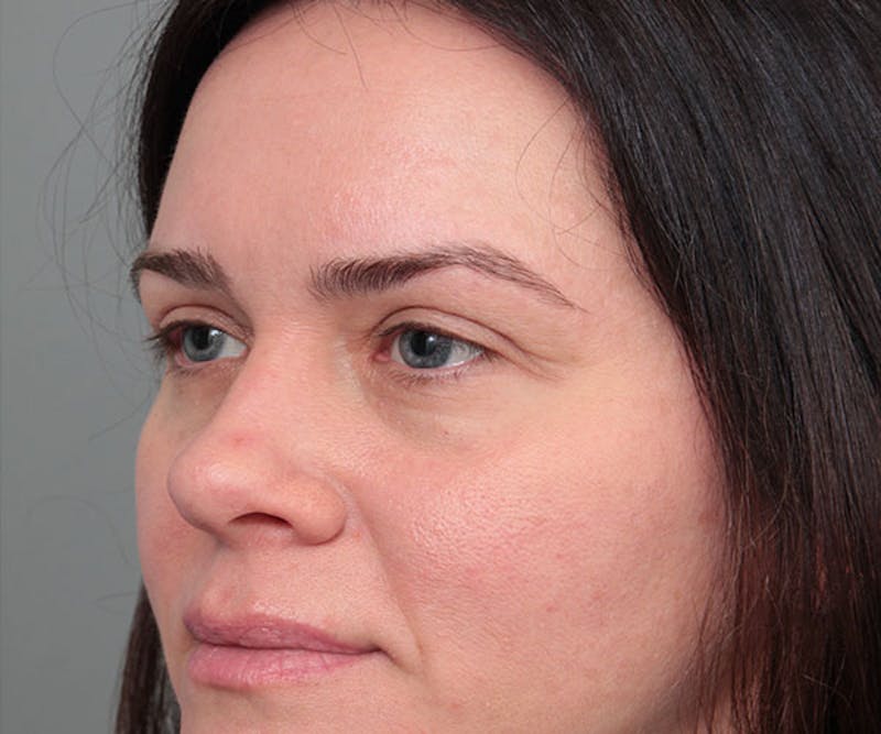 Eyelid Lift Before & After Gallery - Patient 261287 - Image 4 - Scott Chapin, MD