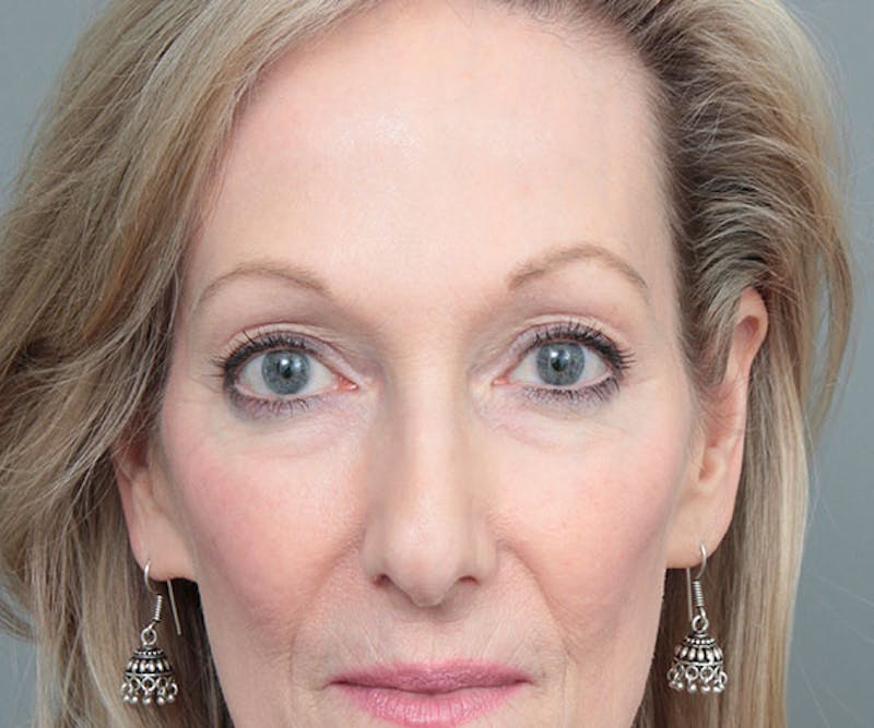 Eyelid Lift Before & After Gallery - Patient 414051 - Image 1 - Scott Chapin, MD