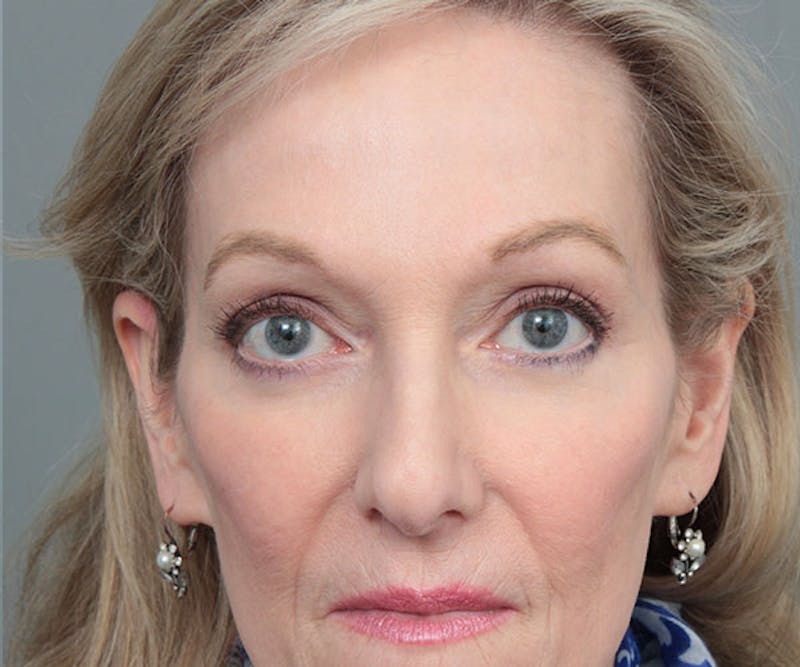 Eyelid Lift Before & After Gallery - Patient 414051 - Image 2 - Scott Chapin, MD