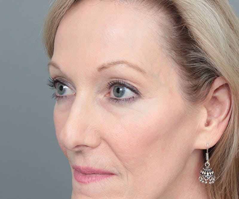 Eyelid Lift Before & After Gallery - Patient 414051 - Image 3 - Scott Chapin, MD