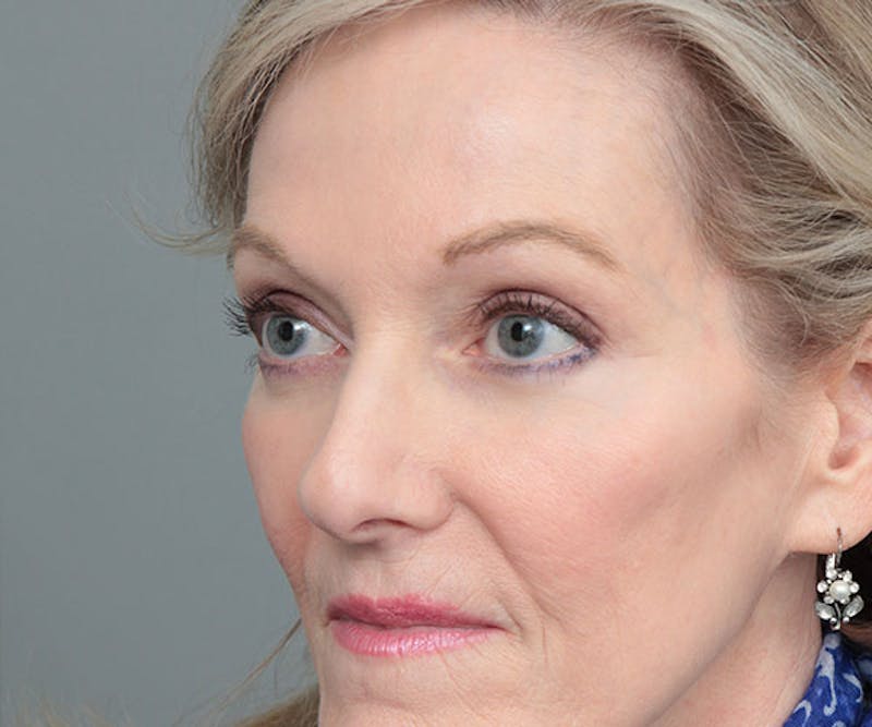 Eyelid Lift Before & After Gallery - Patient 414051 - Image 4 - Scott Chapin, MD