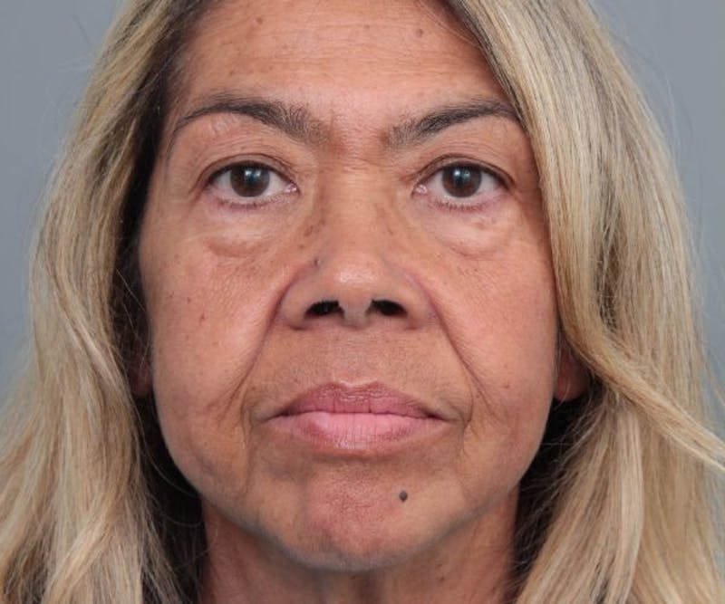 Eyelid Lift Before & After Gallery - Patient 259181 - Image 1 - Scott Chapin, MD