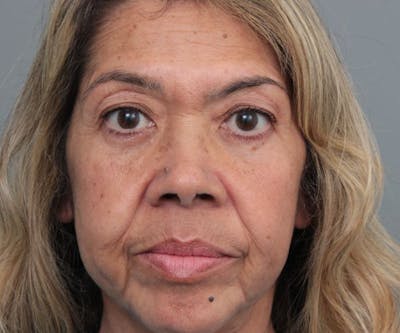 Eyelid Lift Before & After Gallery - Patient 259181 - Image 2 - Scott Chapin, MD