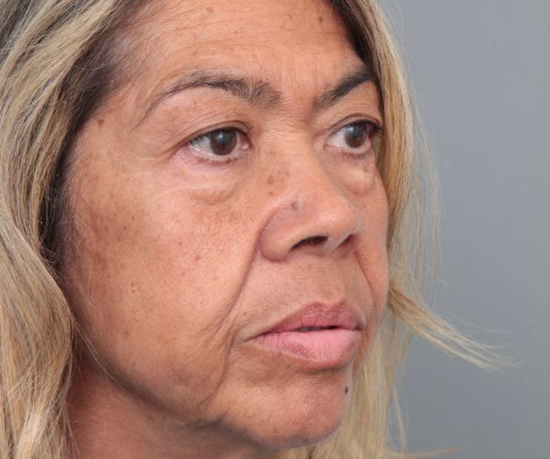 Eyelid Lift Before & After Gallery - Patient 259181 - Image 3 - Scott Chapin, MD
