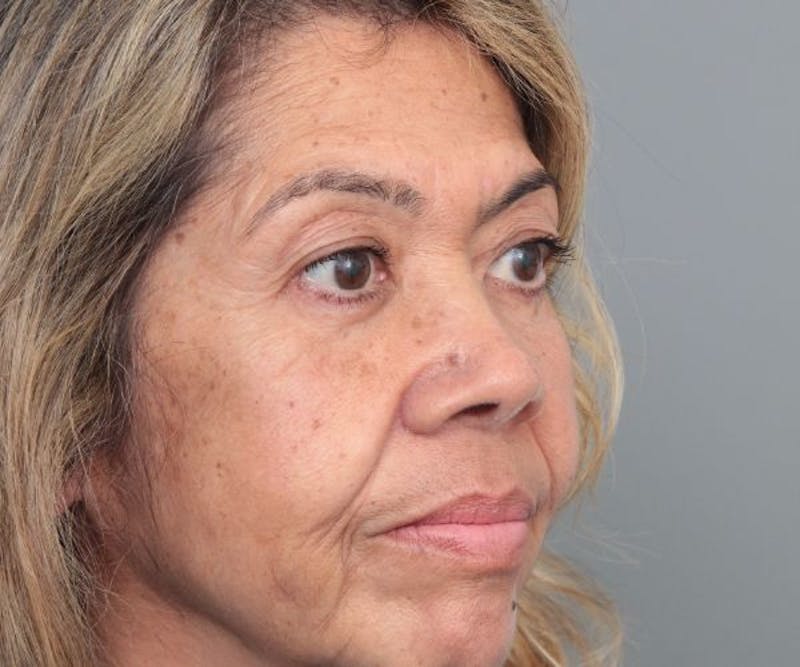 Eyelid Lift Before & After Gallery - Patient 259181 - Image 4 - Scott Chapin, MD