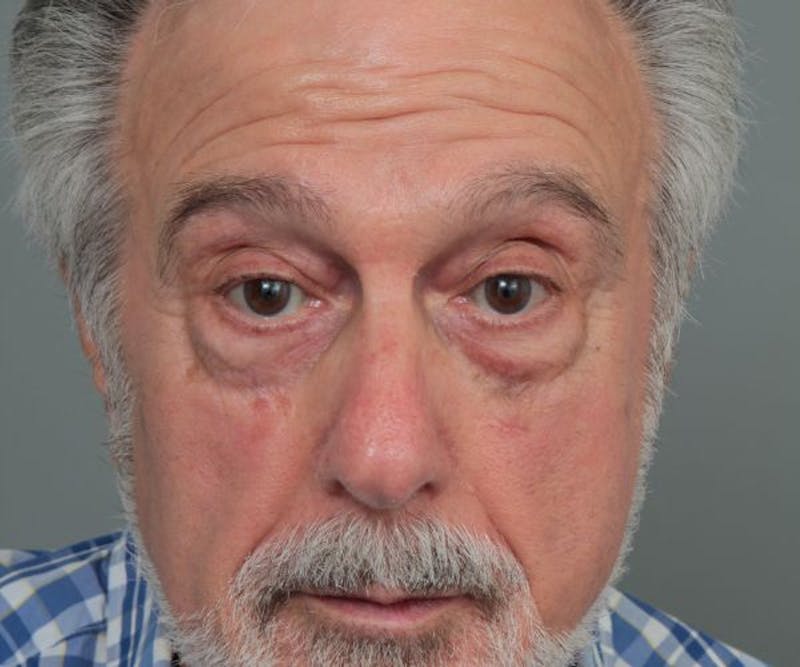 Eyelid Lift Before & After Gallery - Patient 160957 - Image 1 - Scott Chapin, MD