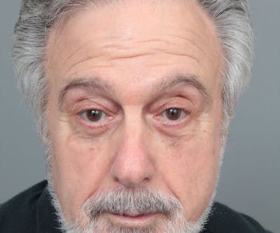 Eyelid Lift Before & After Gallery - Patient 160957 - Image 2 - Scott Chapin, MD
