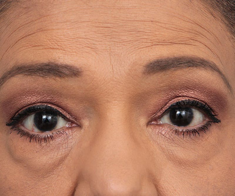 Eyelid Lift Before & After Gallery - Patient 324850 - Image 1 - Scott Chapin, MD