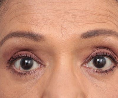 Eyelid Lift Before & After Gallery - Patient 324850 - Image 2 - Scott Chapin, MD