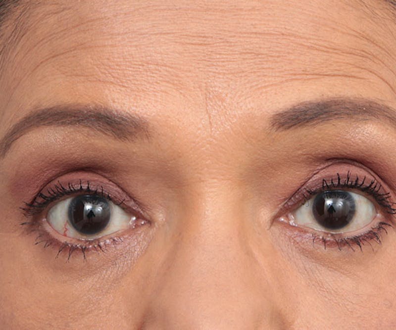 Eyelid Lift Before & After Gallery - Patient 324850 - Image 2 - Scott Chapin, MD