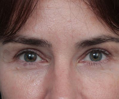 Eyelid Lift Before & After Gallery - Patient 346262 - Image 2 - Scott Chapin, MD