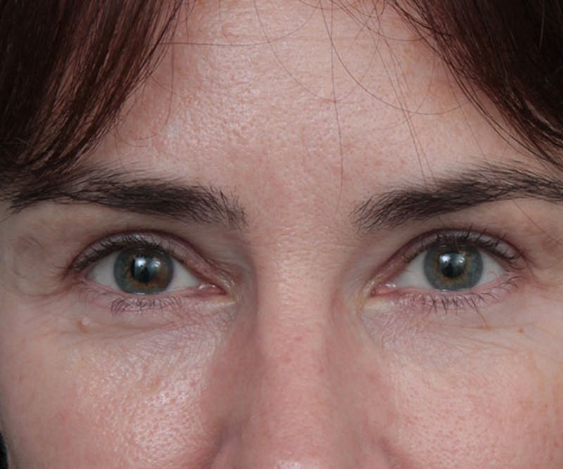 Eyelid Lift Before & After Gallery - Patient 346262 - Image 2 - Scott Chapin, MD