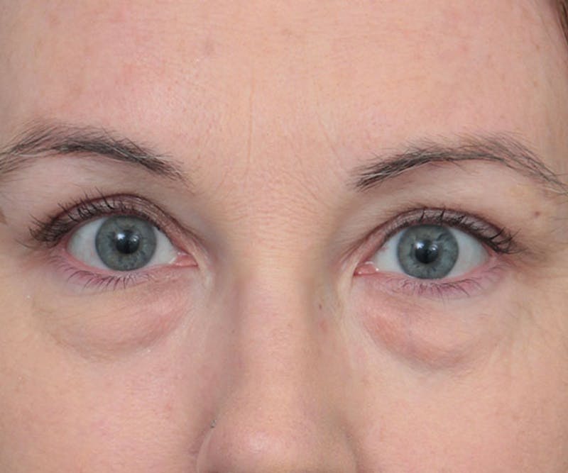 Eyelid Lift Before & After Gallery - Patient 410548 - Image 1 - Scott Chapin, MD