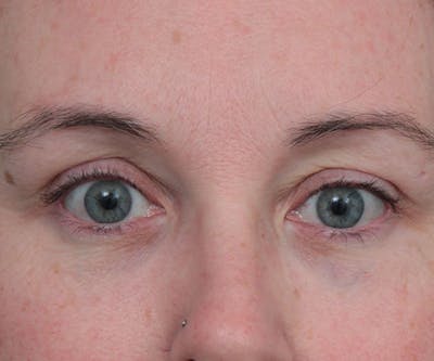 Eyelid Lift Before & After Gallery - Patient 410548 - Image 2 - Scott Chapin, MD
