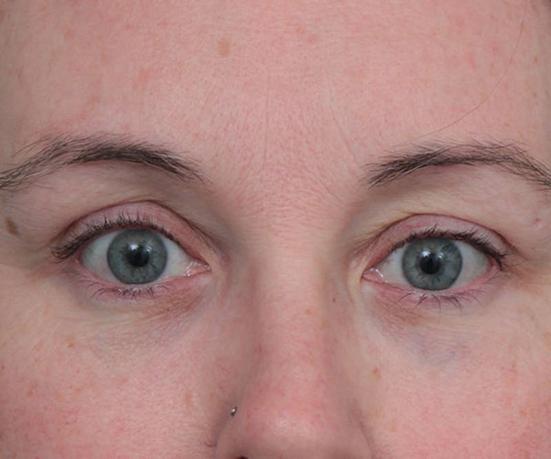Eyelid Lift Before & After Gallery - Patient 410548 - Image 2 - Scott Chapin, MD