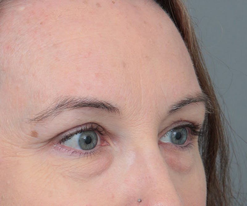 Eyelid Lift Before & After Gallery - Patient 410548 - Image 3 - Scott Chapin, MD