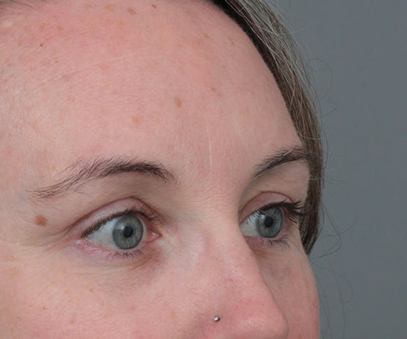 Eyelid Lift Before & After Gallery - Patient 410548 - Image 4 - Scott Chapin, MD