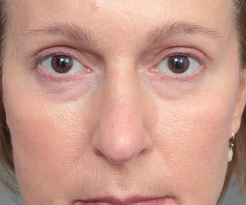 Eyelid Lift Before & After Gallery - Patient 237952 - Image 1 - Scott Chapin, MD