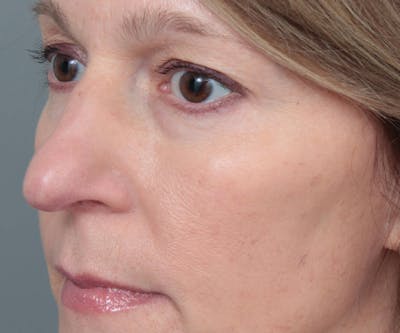 Eyelid Lift Before & After Gallery - Patient 237952 - Image 2 - Scott Chapin, MD