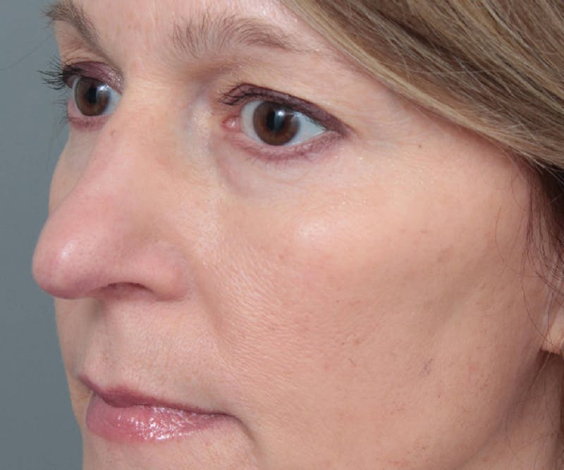 Eyelid Lift Before & After Gallery - Patient 237952 - Image 2 - Scott Chapin, MD