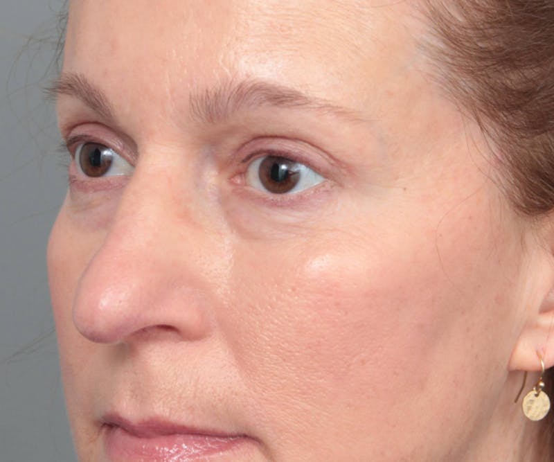 Eyelid Lift Before & After Gallery - Patient 237952 - Image 3 - Scott Chapin, MD