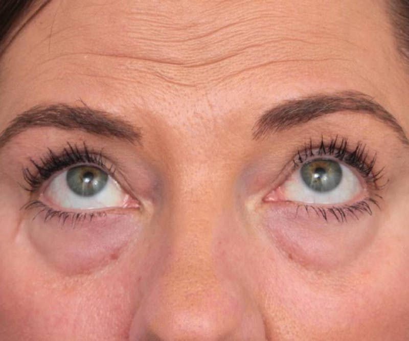 Eyelid Lift Before & After Gallery - Patient 766128 - Image 1 - Scott Chapin, MD