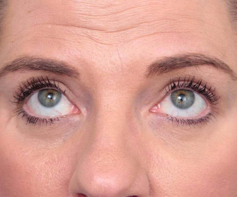 Eyelid Lift Before & After Gallery - Patient 766128 - Image 2 - Scott Chapin, MD