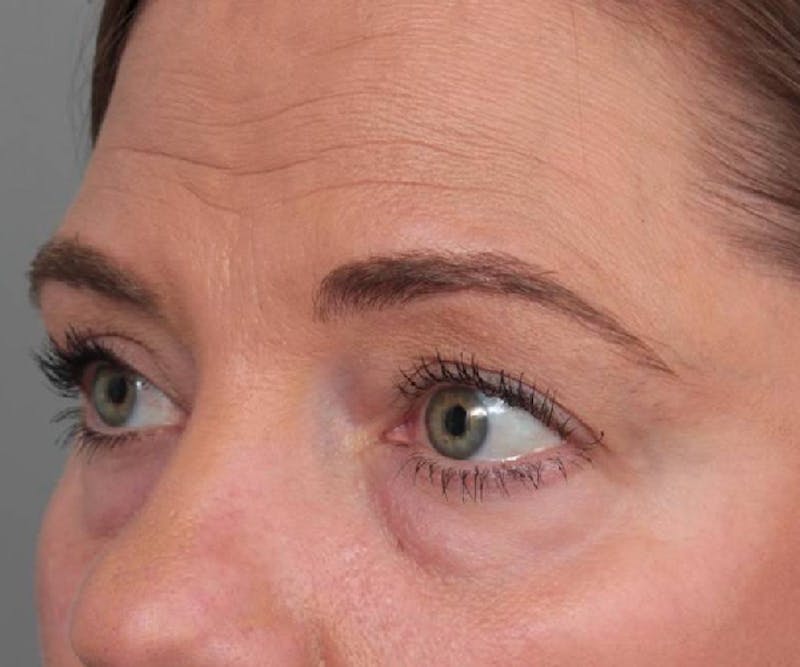 Eyelid Lift Before & After Gallery - Patient 766128 - Image 3 - Scott Chapin, MD