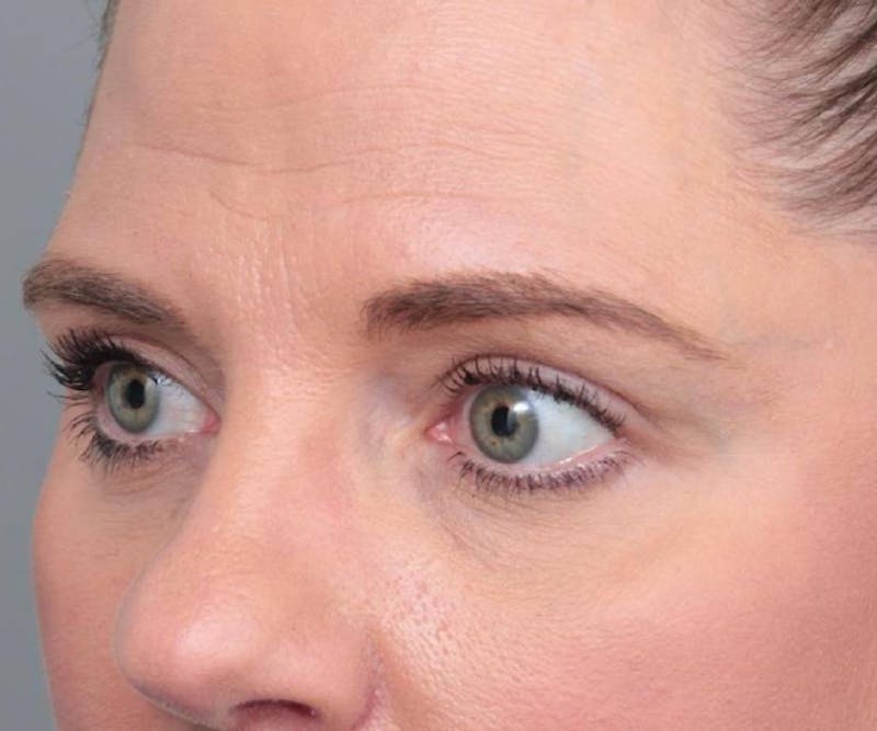 Eyelid Lift Before & After Gallery - Patient 766128 - Image 4 - Scott Chapin, MD