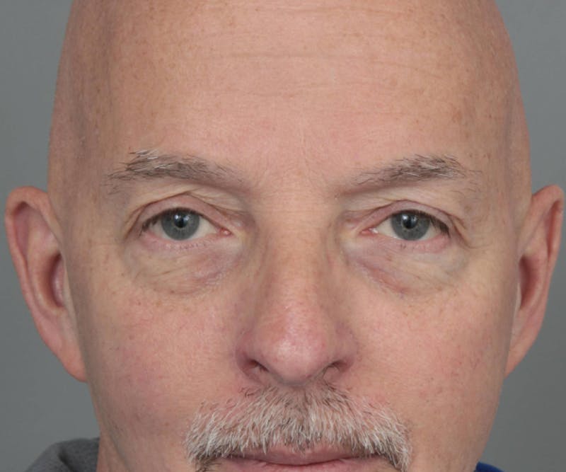 Eyelid Lift Before & After Gallery - Patient 158349 - Image 1 - Scott Chapin, MD