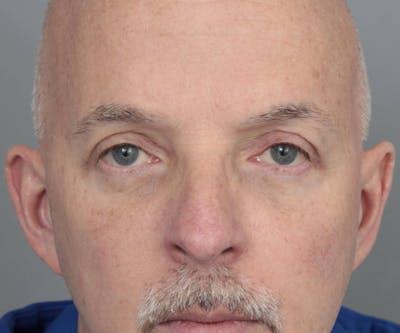 Eyelid Lift Before & After Gallery - Patient 158349 - Image 2 - Scott Chapin, MD