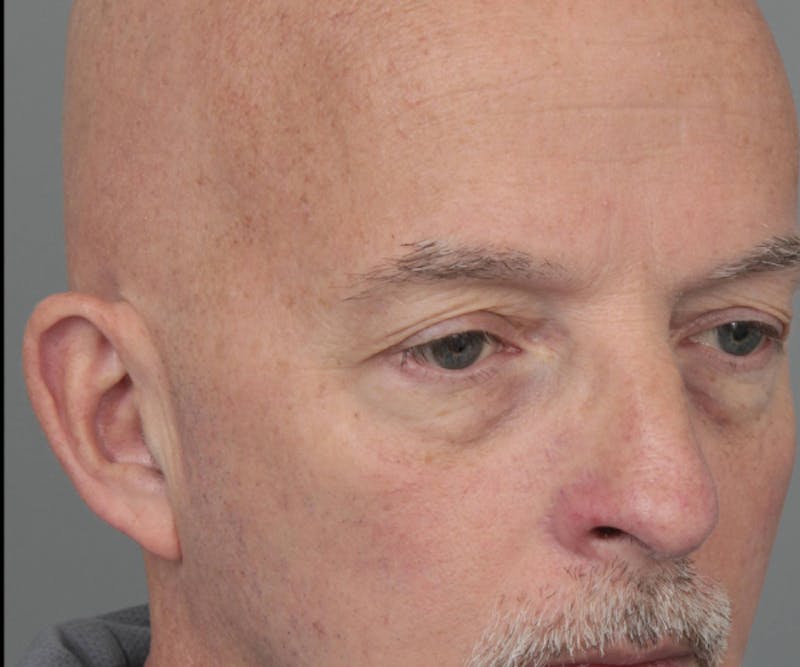 Eyelid Lift Before & After Gallery - Patient 158349 - Image 3 - Scott Chapin, MD