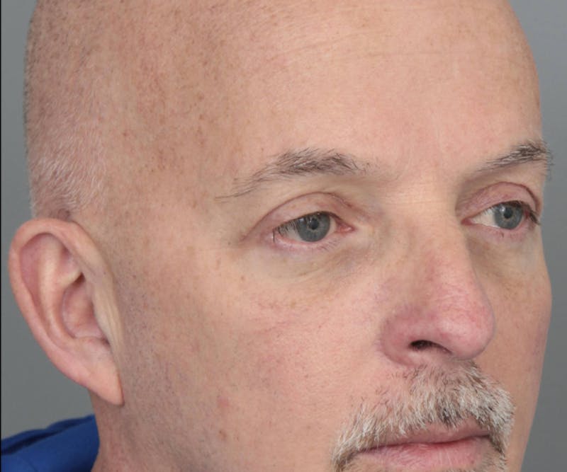 Eyelid Lift Before & After Gallery - Patient 158349 - Image 4 - Scott Chapin, MD