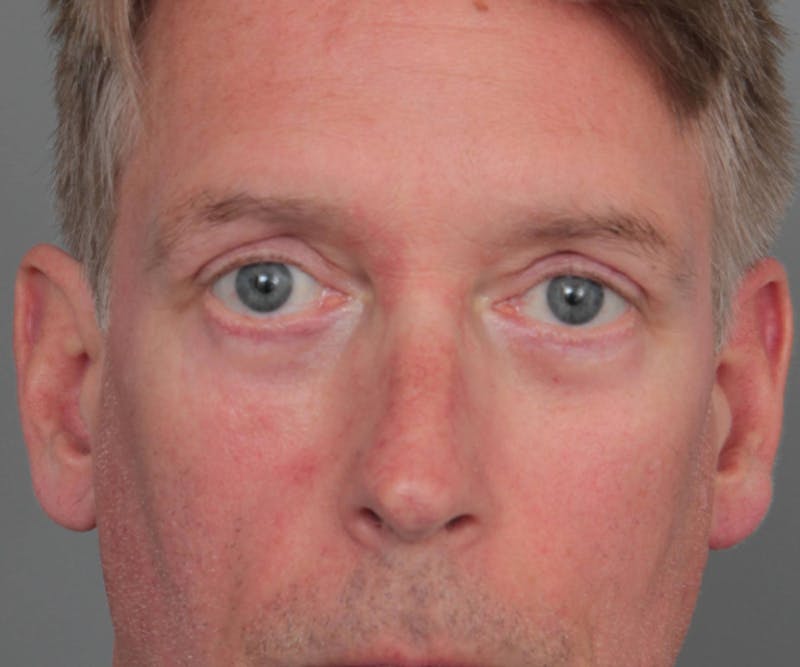 Eyelid Lift Before & After Gallery - Patient 480111 - Image 2 - Scott Chapin, MD