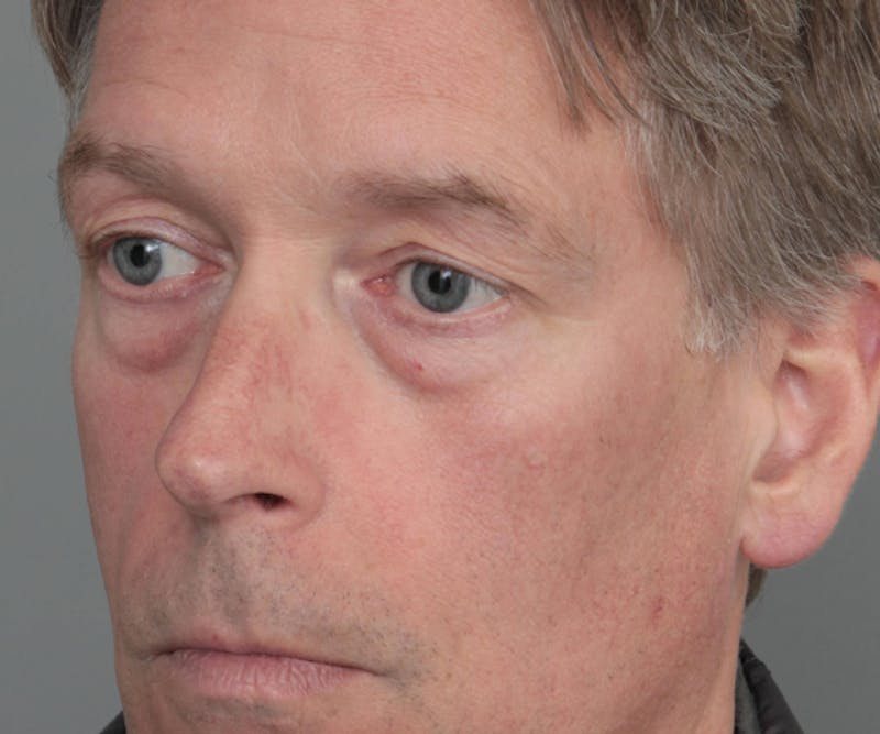 Eyelid Lift Before & After Gallery - Patient 480111 - Image 3 - Scott Chapin, MD